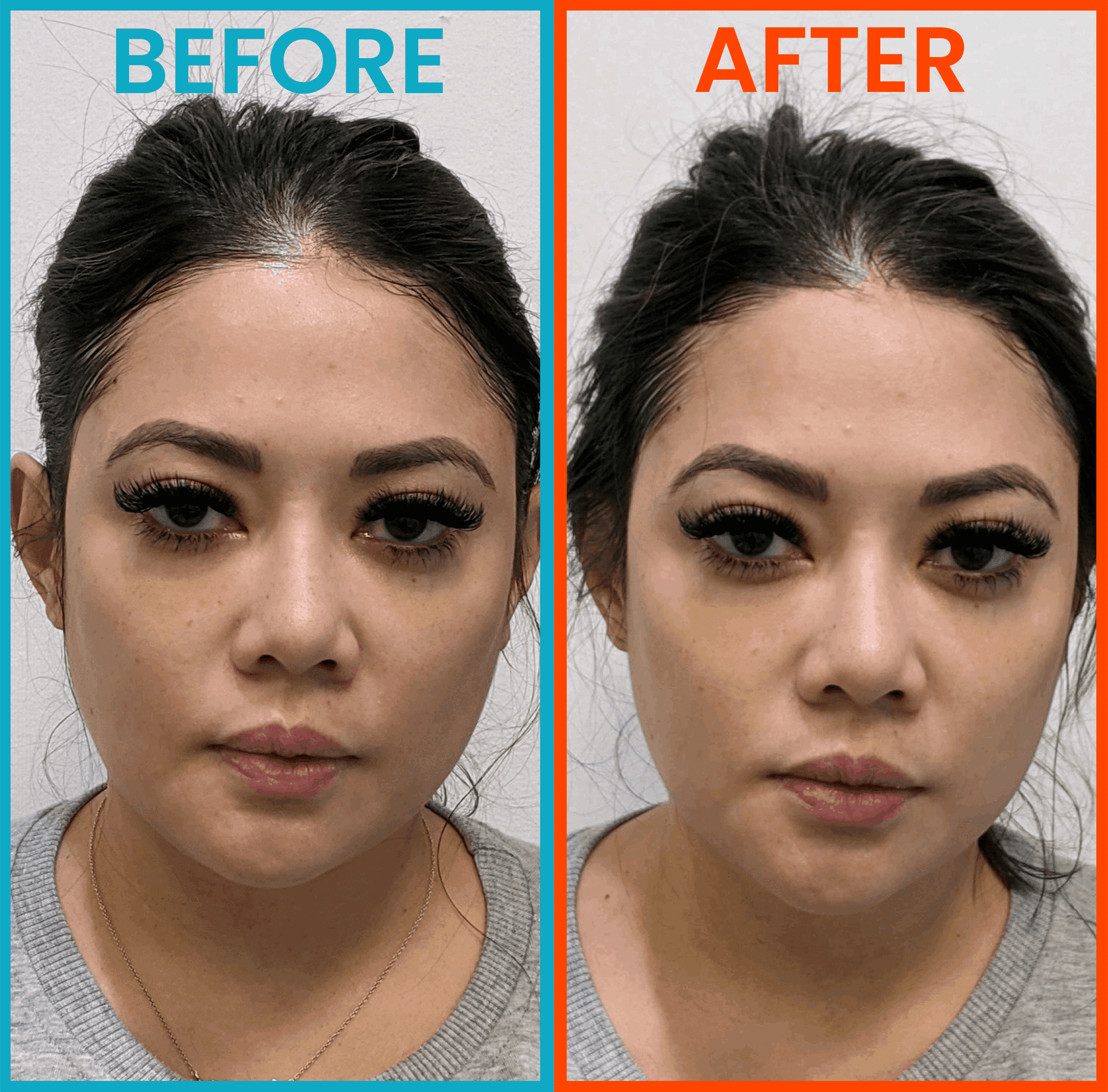 Before & After HIFU Facelift in Milpitas